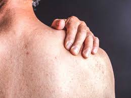 How Is Scalp Psoriasis Causes