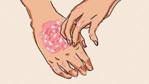 Psoriasis Cure Leaky Gut
