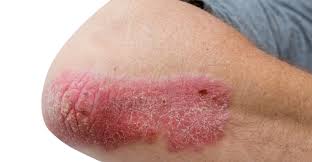 Psoriasis In Dogs