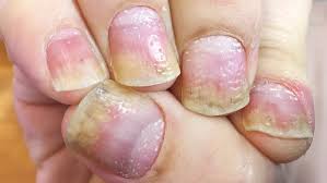 Scalp Psoriasis Plaques