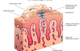 Which Medicine Is Used For Psoriasis