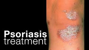 Can Guttate Psoriasis Be Cured