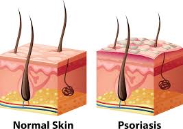 Skin Psoriasis Reason