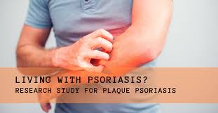 Scalp Psoriasis Plaques