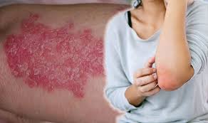 Psoriasis Cure Leaky Gut