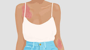 What Helps Psoriasis