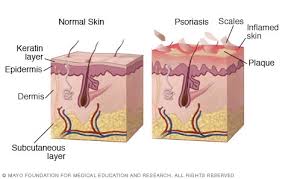 Psoriasis Cure Leaky Gut
