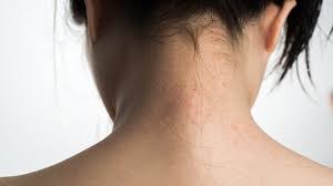 Psoriasis Usmle