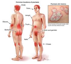Psoriasis Cure Leaky Gut
