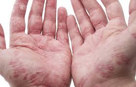 Psoriasis Cure Leaky Gut