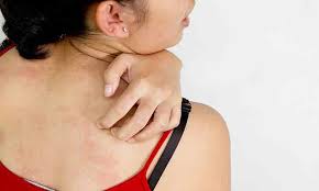 Which Treatment Is Best For Scalp Psoriasis