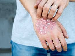 How Is Scalp Psoriasis Causes