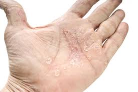 Psoriasis Cure Leaky Gut