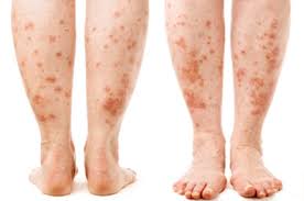 Psoriasis Cure Leaky Gut