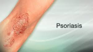 Scalp Psoriasis Toddler