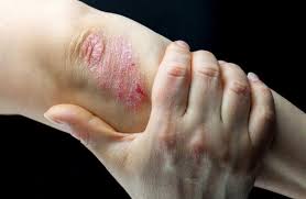 Psoriasis  Skin Clinic Capalaba Qld